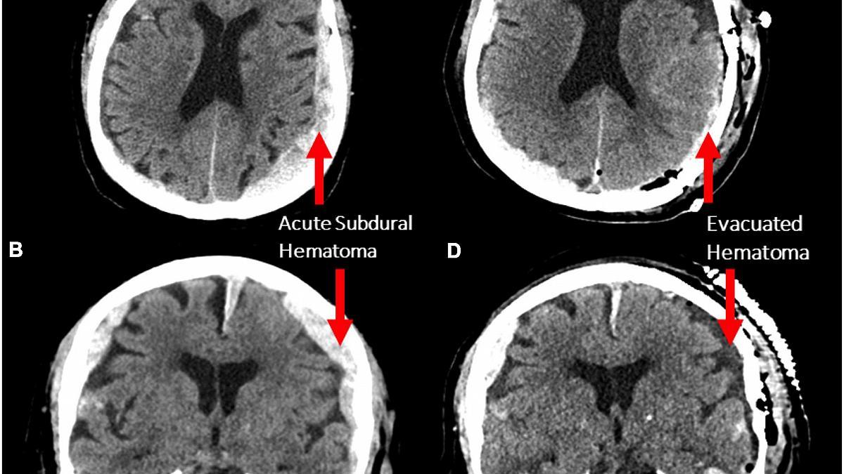 ABD'de Ölen Bir Kişinin Son Beyin Aktiviteleri Tesadüfen İlk Kez Kayıt Altına Alındı