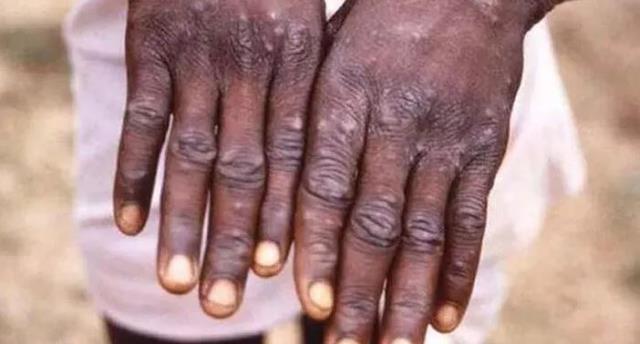 Maymun Çiçeği Hastalığı Avustralya'ya da Sıçradı!