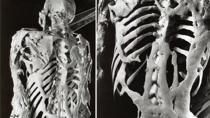 Taş Adam Sendromu Nedir?