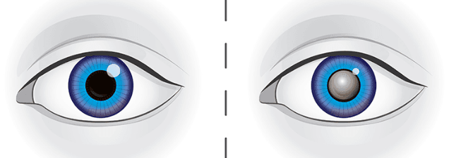 Görme Bozuklukları Nelerdir?