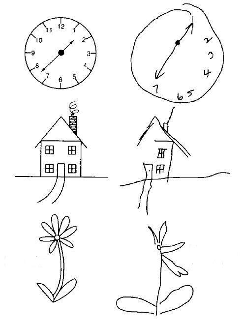Hayatı Yarım Yaşamak: Hemispatial İhmal
