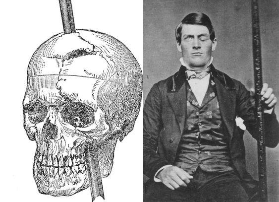 Phineas Gage’in Tuhaf Hikayesi