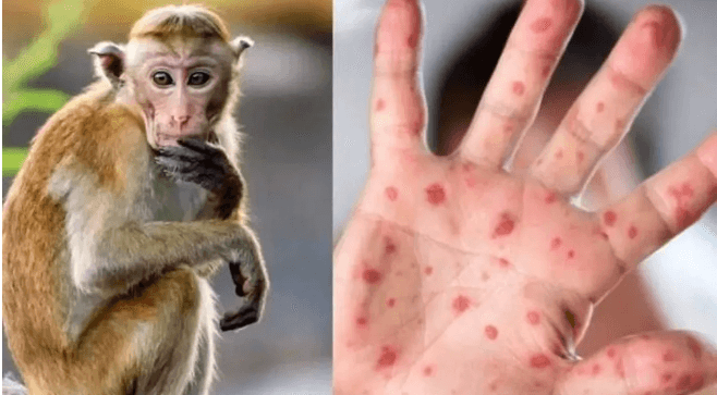 Maymun Çiçeği için küresel acil durum bildirisi!