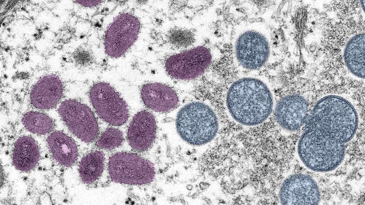 Bir İtalyanda Covid, Maymun Çiçeği Ve HIV Aynı Anda Görüldü