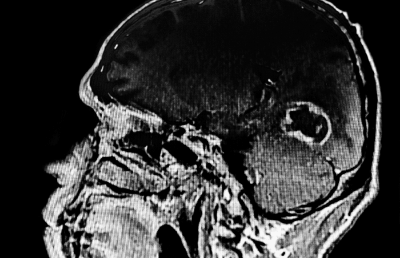 Bu Parazit Beyninizi Kontrol Edebiliyor: Toksoplazma Hakkında Bilmeniz Gerekenler