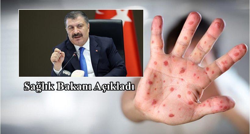 Türkiye'de Maymun Çiçeği Vakası Artıyor